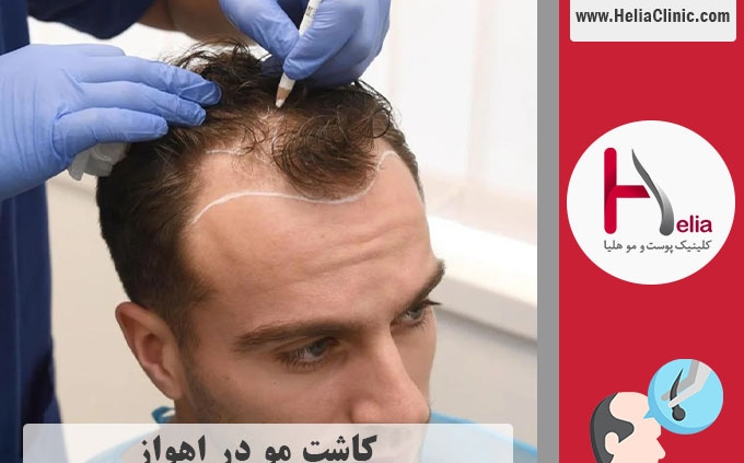 کاشت موی طبیعی در اهواز