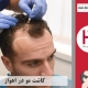 کاشت موی طبیعی در اهواز