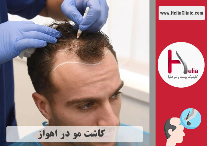 کاشت موی طبیعی در اهواز
