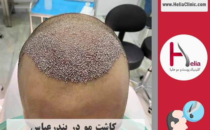 کاشت مو در شهر بندر عباس