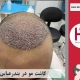 کاشت مو در شهر بندر عباس