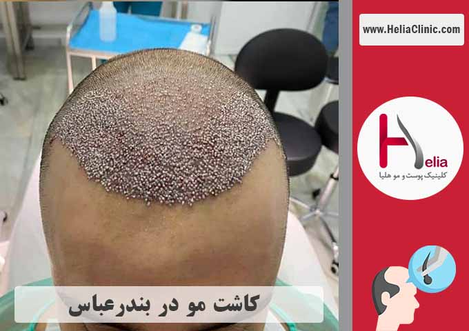 کاشت مو در شهر بندر عباس