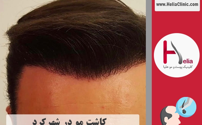 کاشت موی طبیعی در شهرکرد