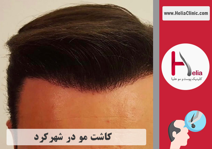 کاشت موی طبیعی در شهرکرد