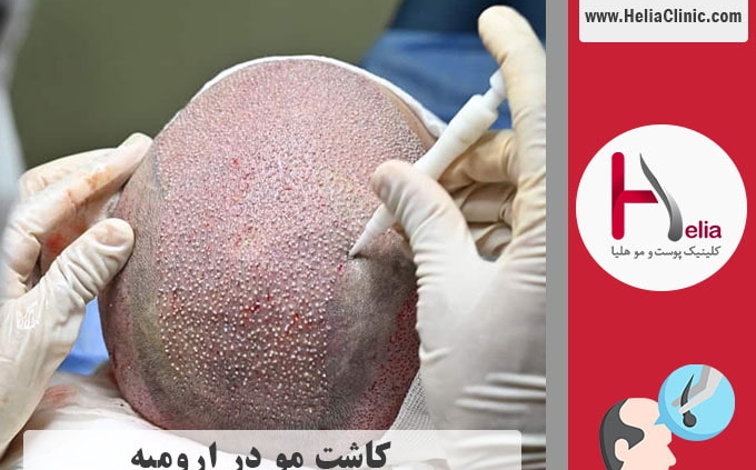 کاشت موی طبیعی ارومیه