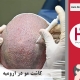 کاشت موی طبیعی ارومیه