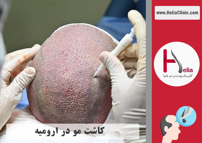 کاشت موی طبیعی ارومیه
