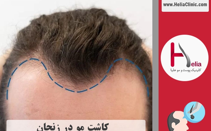 کاشت مو حرفه ای در زنجان