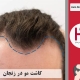 کاشت مو حرفه ای در زنجان