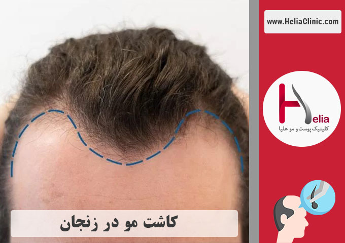 کاشت مو حرفه ای در زنجان