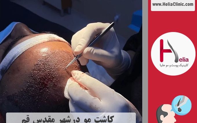 کاشت مو فم