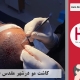 کاشت مو فم