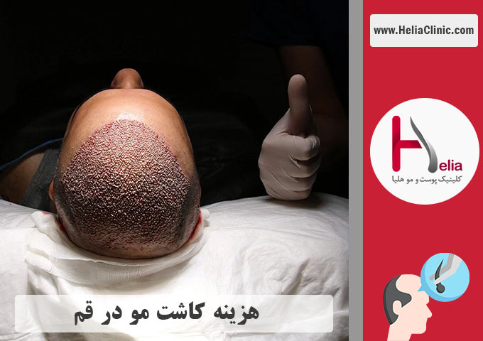 هزینه کاشت موی طبیعی در قم