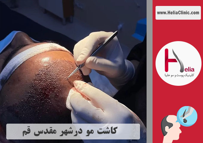 کاشت مو فم