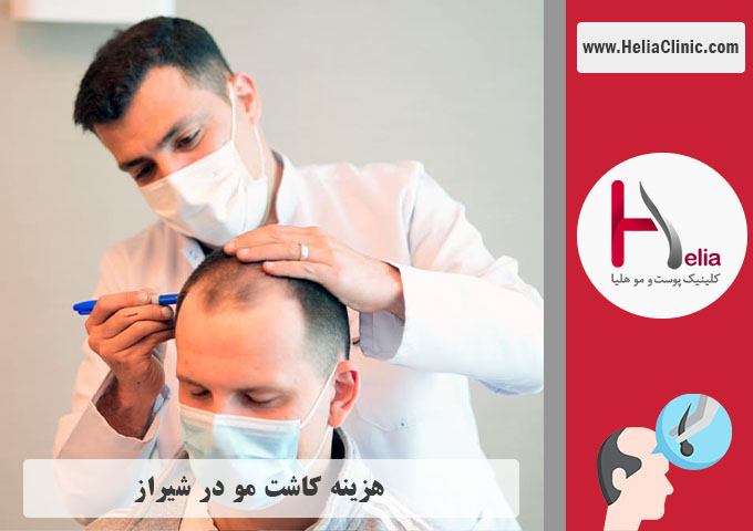 قیمت کاشت موی طبیعی در شیراز