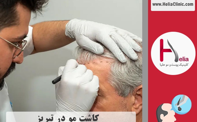 کاشت مو تبریز