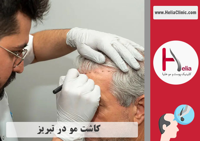 کاشت مو تبریز