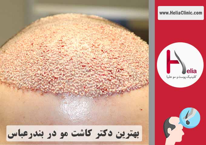 بهترین دکتر و کلینیک کاشت موی طبیعی در بندرعباس
