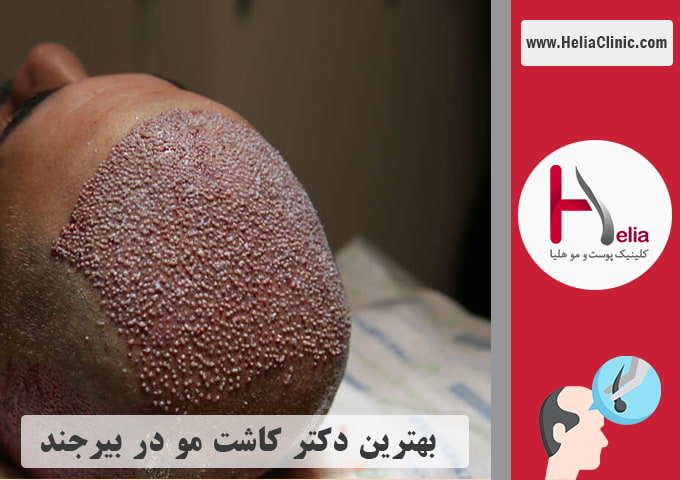 بهترین دکتر و کلینیک تخصصی کاشت مو در بیرجند