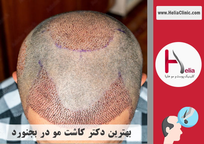 بهترین دکتر متخصص کاشت مو در بجنورد