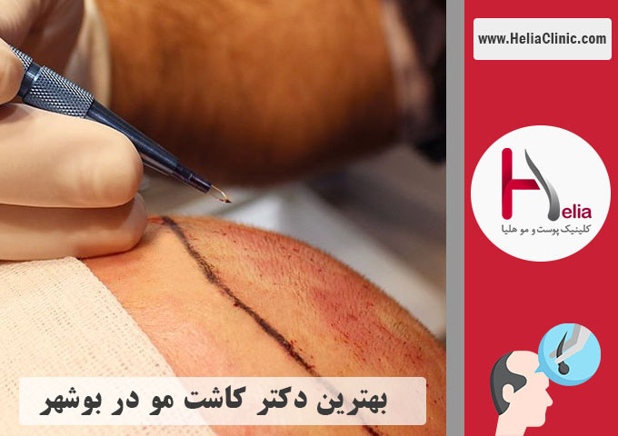 بهترین دکتر متخصص و مرکز کاشت مو در شهر بوشهر
