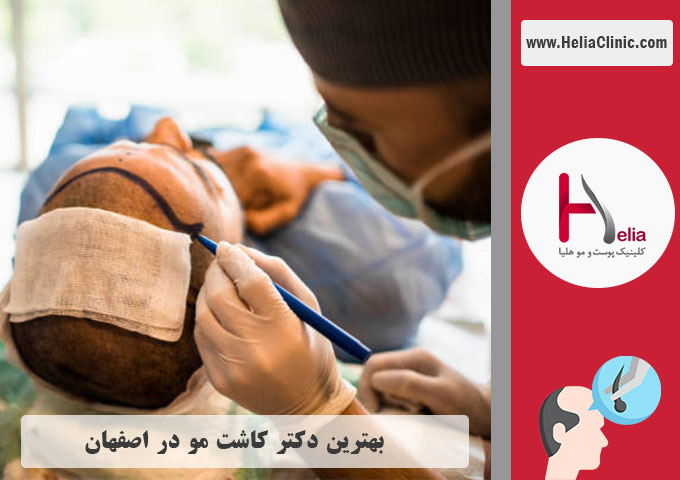 بهترین دکتر و کلینیک کاشت مو در اصفهان