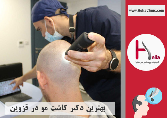 بهترین کلینیک و دکتر کاشت مو در قزوین