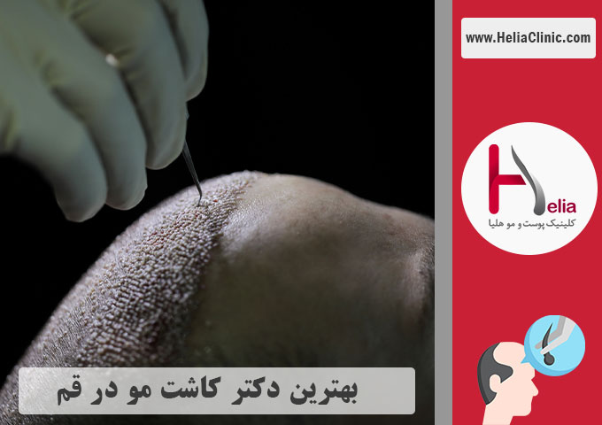 بهترین دکتر و کلینیک کاشت مو در قم