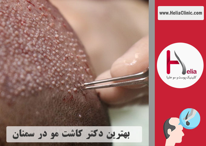 بهترین دکتر و کلینیک تخصصی کاشت مو در سمنان