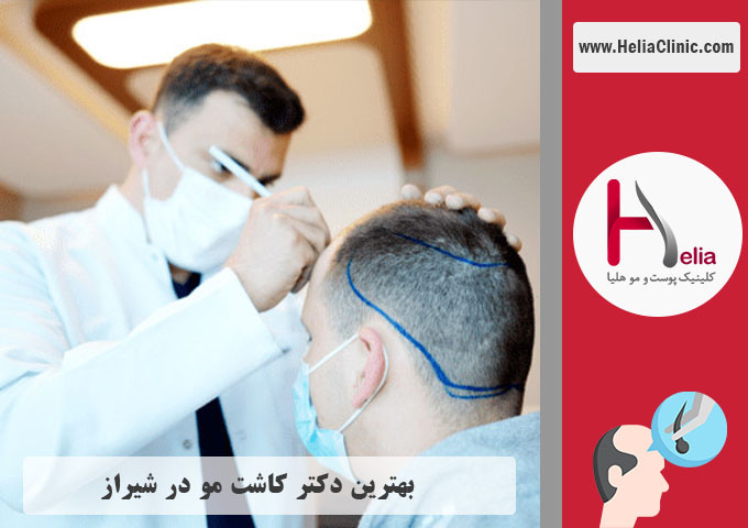 بهترین دکتر و کلینیک تخصصی کاشت مو در شیراز