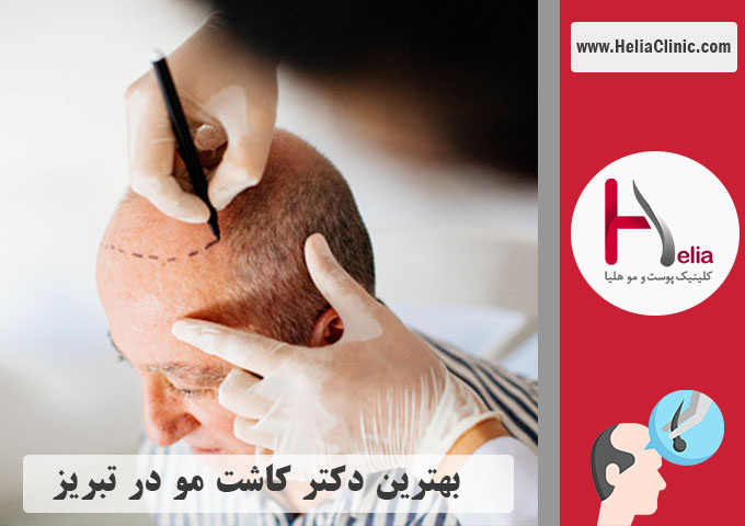 بهترین دکتر و کلینیک کاشت موی طبیعی در تبریز