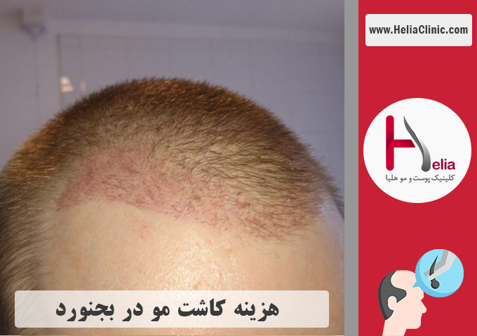 هزینه کاشت مو در بجنورد