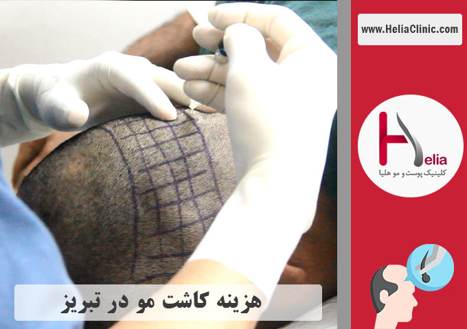 قیمت کاشت موی طبیعی در شهر تبریز