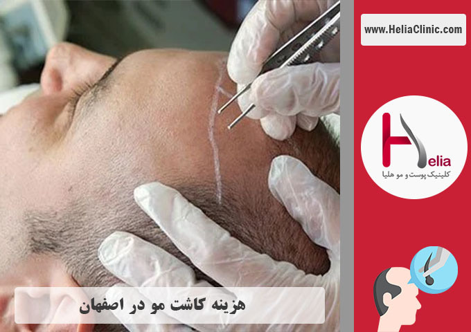 هزینه کاشت مو در شهر اصفهان