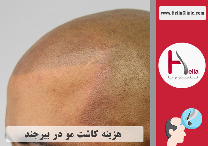 هزینه کاشت مو در بیرجند