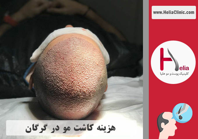 قیمت کاشت موی طبیعی در گرگان