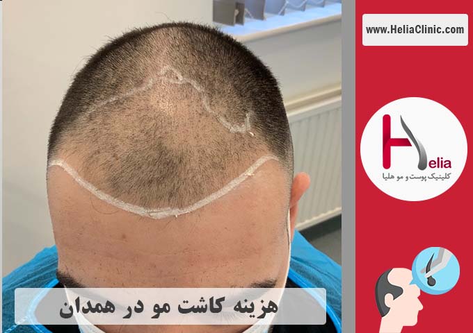 قیمت کاشت موی طبیعی در همدان
