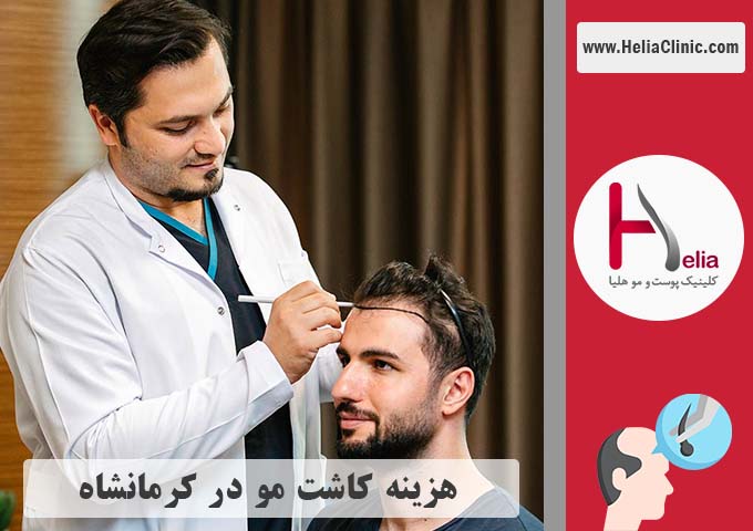 قیمت کاشت مو در کرمانشاه