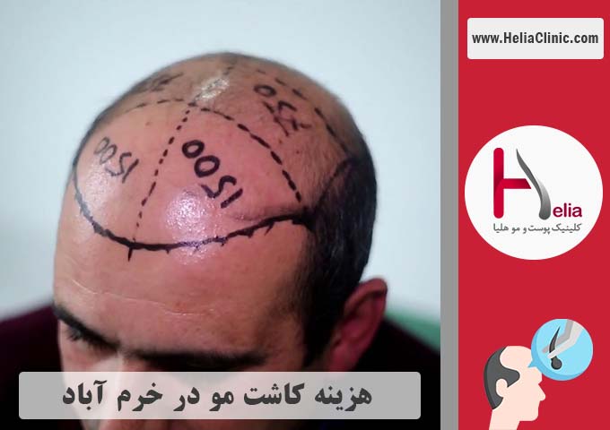 قیمت کاشت موی طبیعی در خرم آباد - لرستان