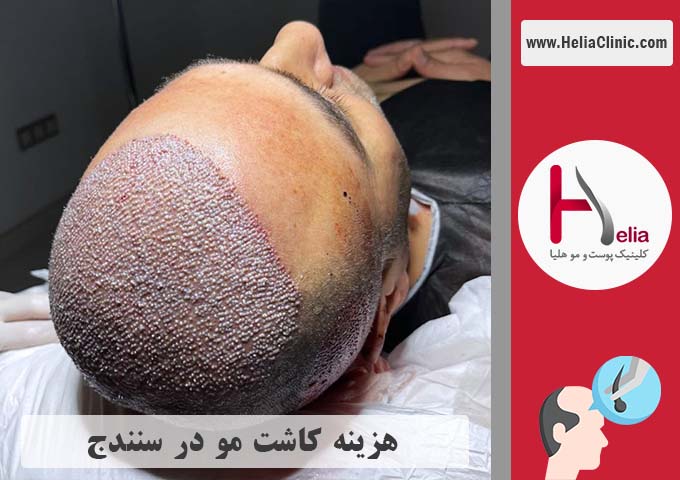 قیمت کاشت موی طبیعی در سنندج