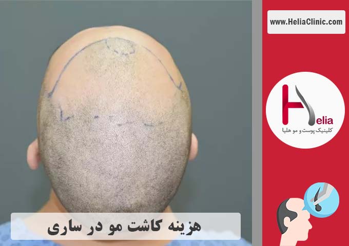 قیمت کاشت موی طبیعی در شهر ساری - مازندران