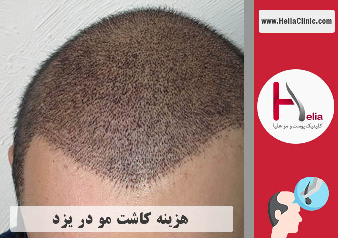 قیمت کاشت مو در شهر یزد