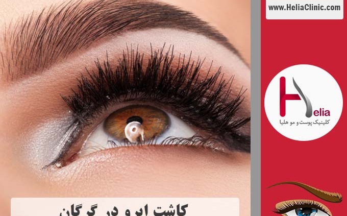 کاشت ابرو در شهر گرگان