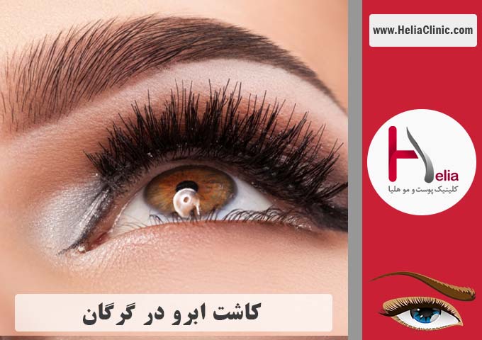 کاشت ابرو در شهر گرگان
