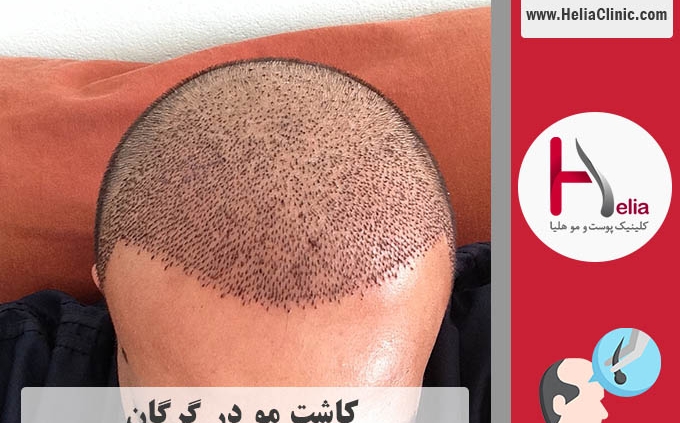 کاشت مو در گرگان | استان گلستان