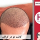 کاشت مو در گرگان | استان گلستان