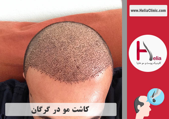 کاشت مو در گرگان | استان گلستان