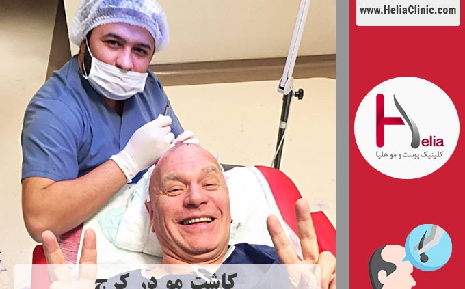 کاشت موی طبیعی در شهر کرج
