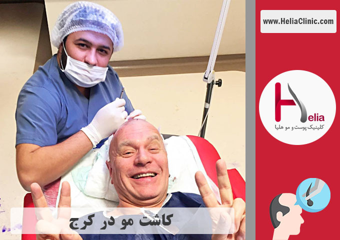کاشت موی طبیعی در شهر کرج