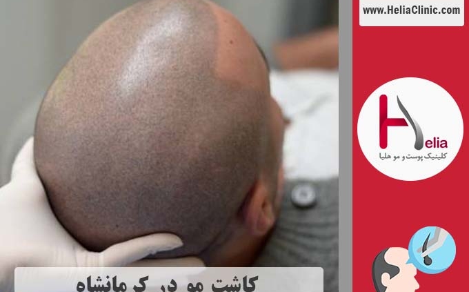 کاشت موی طبیعی در شهر کرمانشاه
